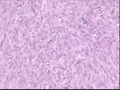 leiomyosarcoma