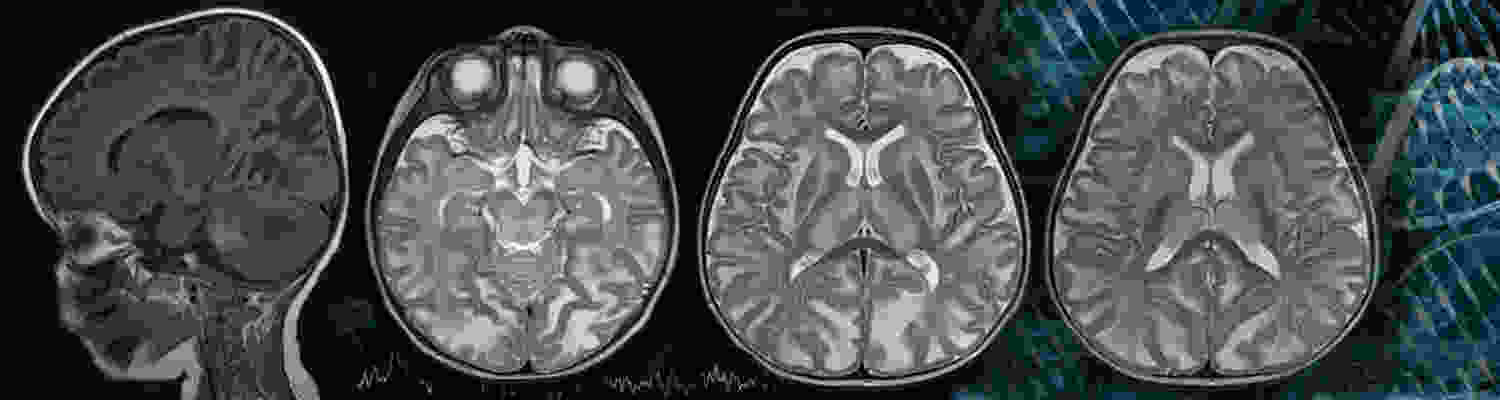 gene-therapy-research-and-therapeutic-strategies-for-canavan-disease-guangping-gao-lab-horae-gene-therapy-research-center.jpg