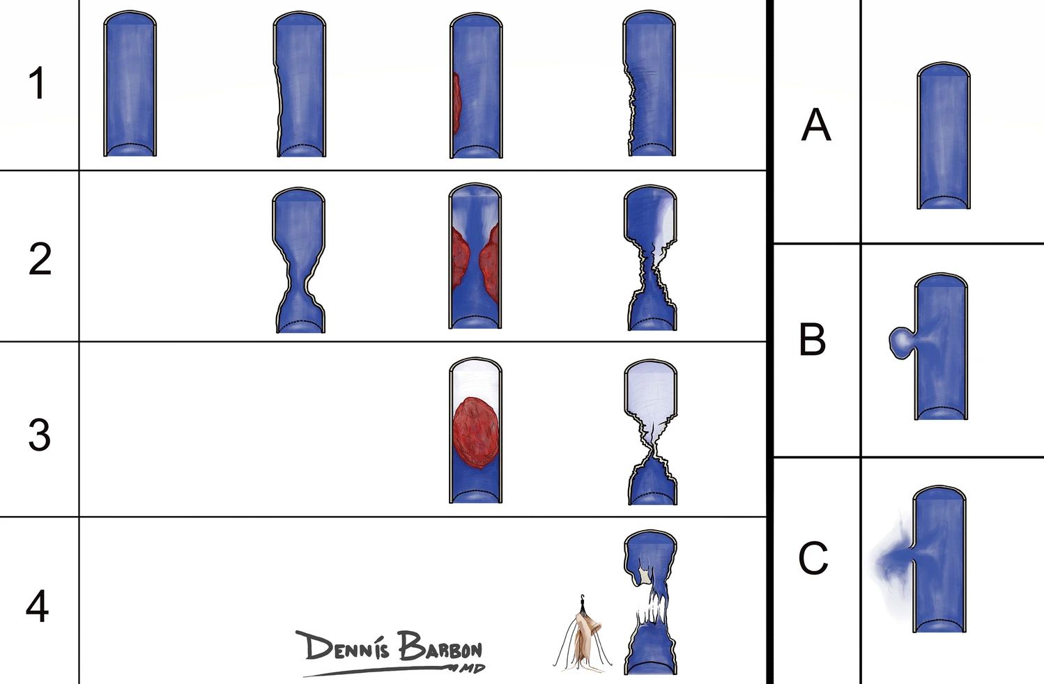 IVC Injury Classification System