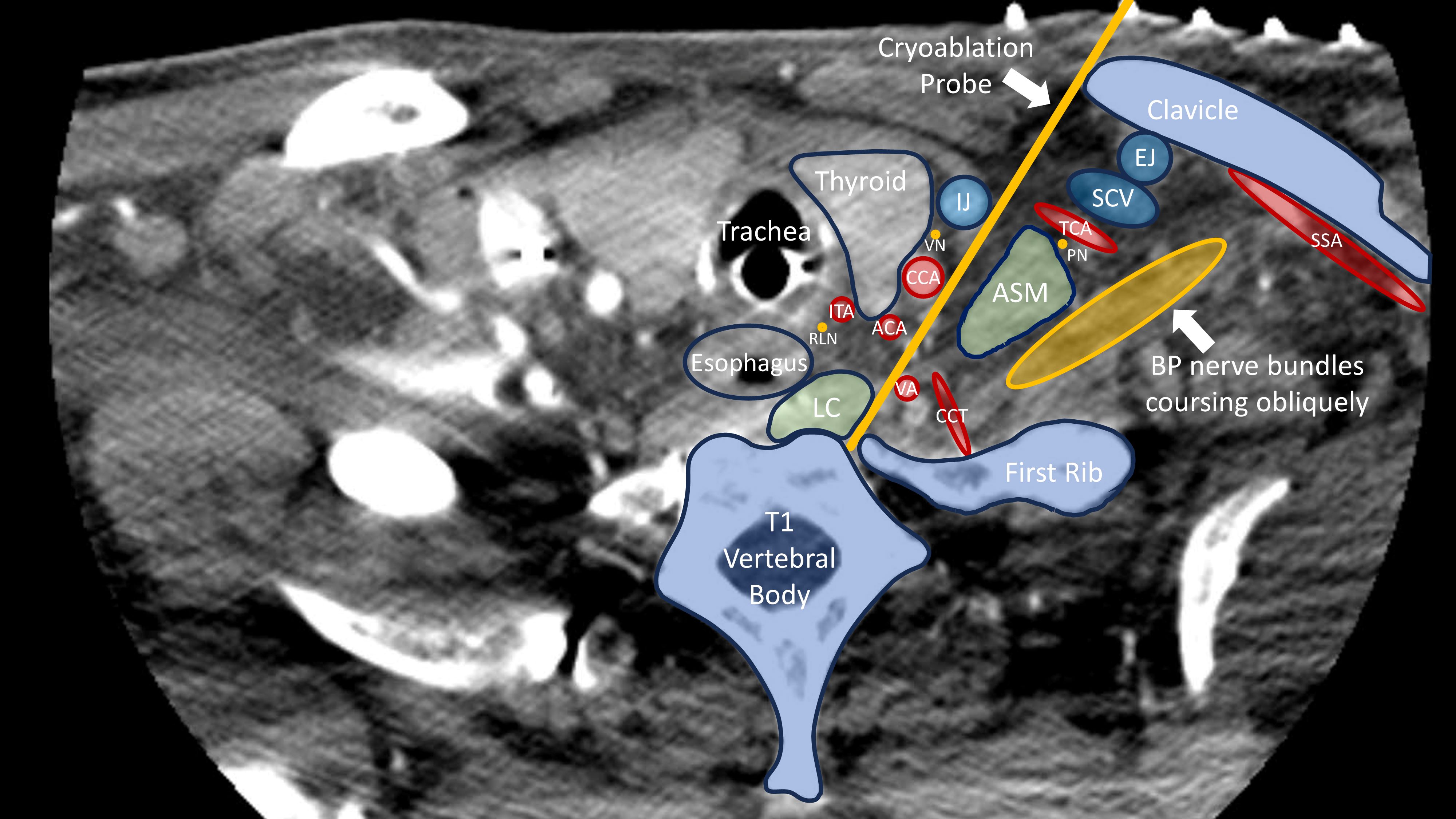 Stellate Ganglion Cryoneurolysis