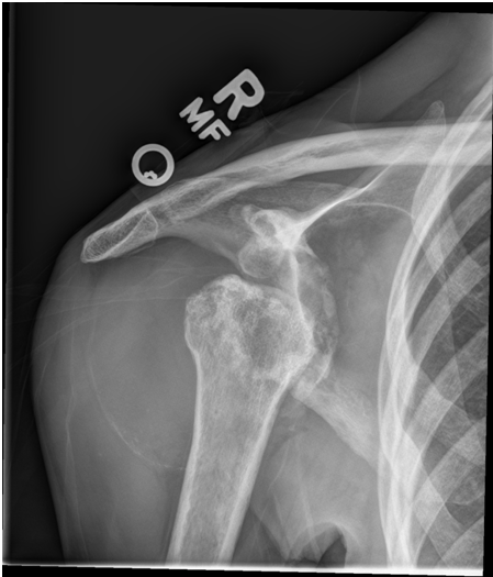 AP radiograph