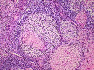 Chronic-Granulomatous-300x225.jpg